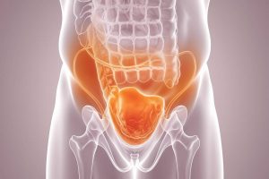 Is Bowel Leakage a Sign of Cancer? What Your Body Warns 14 Is Bowel Leakage a Sign of Cancer