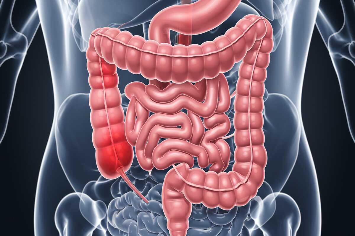 Is Low Potassium a Sign of Cancer? Essential Information 3 Illustration showing the progression of colon cancer in the colon.
