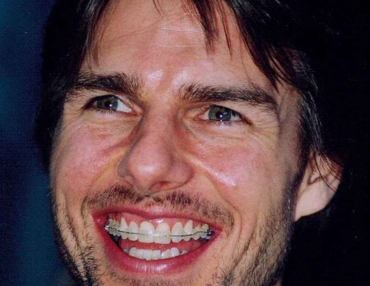5 Shocking Secrets Behind Tom Cruise Teeth Transformation 2 Adult Orthodontics Changed Everything